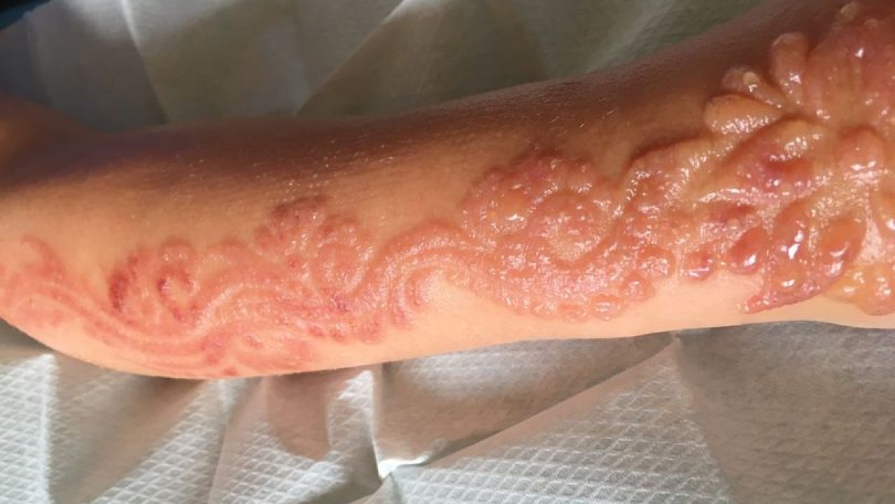 Una niña sufre graves quemaduras por un tatuaje de henna
